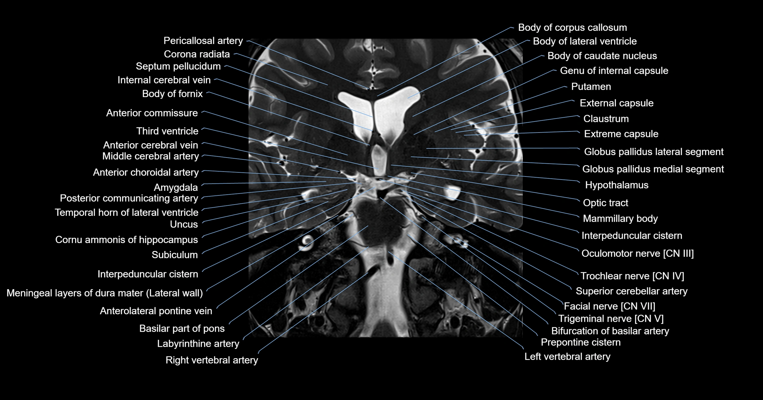 MRI brainstem & basal ganglia anatomy labelled 3T MRI images -img-00001-00017.webp